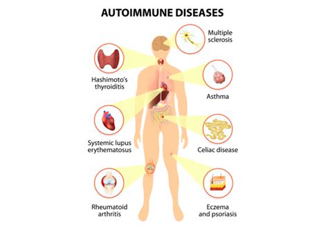 what other autoimmune diseases are similar to lupus